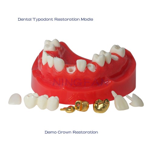 Dental Restorations Model Upper/Lower Jaw Onlay/Crown/Veneer/Bridge Removable - Picture 5 of 11