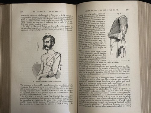 Practical Treatise Fractures Dislocations Frank Hastings Hamilton ~ 1871 Medical - Picture 8 of 9