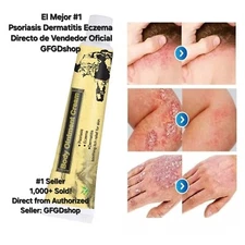Crema Para Dermatitis Eczema Psoriasis Para Comezon Picazon Ronchas En La Piel