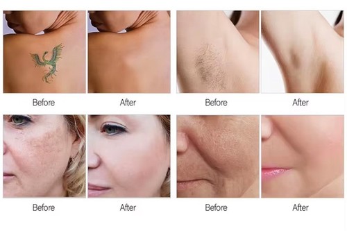 Picosekundenlaser Tattooentfernungsgerät Eis Titan Diodenlaser Haarentfernung - Bild 5 von 6