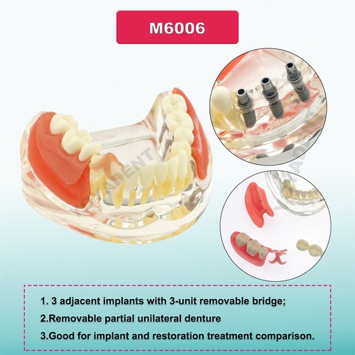 Multiple Types Dental Teeth Model Ortho Implant Practice Teaching Demo Model - Picture 98 of 276