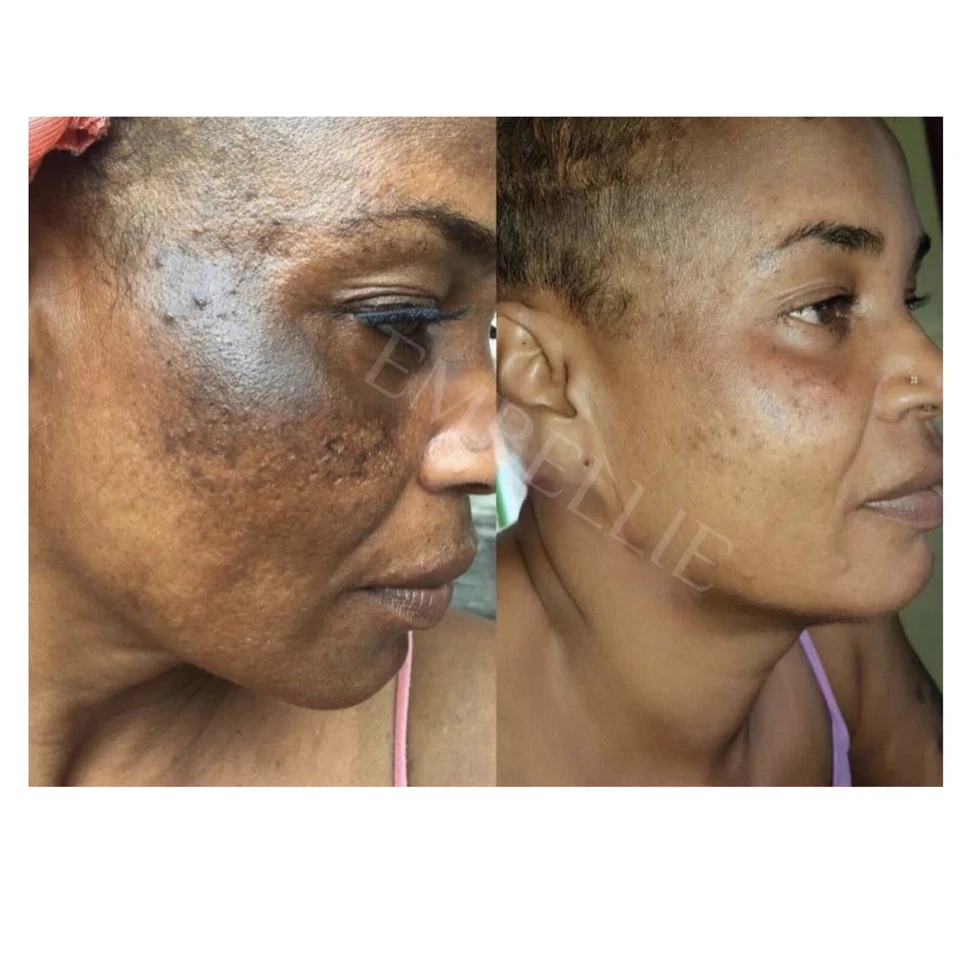 Aceite sérico removedor de quemaduras solares, suero Dark Mark Fade Foto 2 de 4