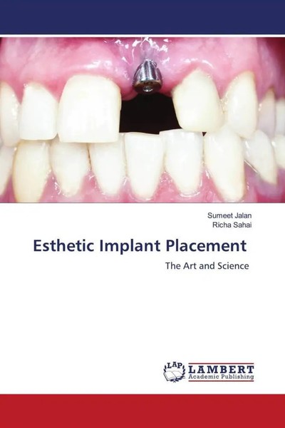 Sumeet Jalan (U. A.) | Esthetic Implant Placement | Taschenbuch | Englisch-image