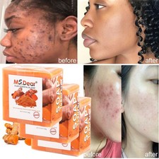 1 3 Turmeric Soap for Face Body,Skin Brightening Anti-Acne Dark Spots Lightening