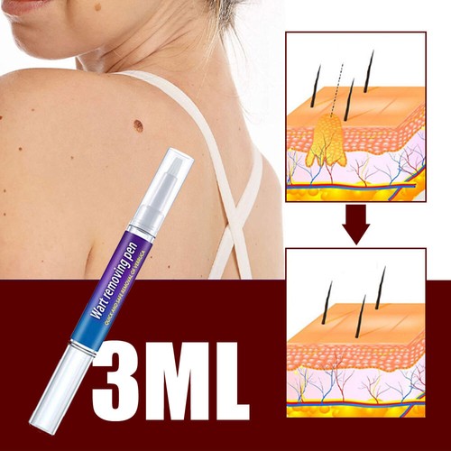 12 Hours Wart Remover Pen Eliminate Skin Tag Foot Corn Mole Warts