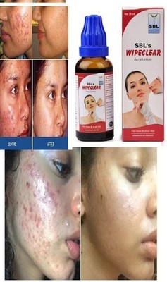 SBL Wipe Clear Acne Lotion for Acne, Pimples, Boils and Blotches 30 ml X 5 FRSP
