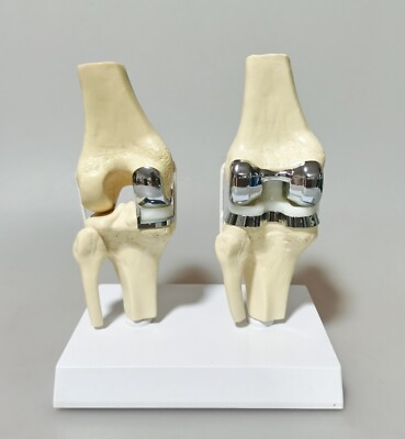Detachable Artificial Knee Prosthesis Medical Anatomical Teaching Demo Model