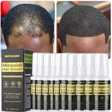 Minoxidil 5 Extra Strength for Men Hair Growth Spray Anti Hair Loss Regrowth