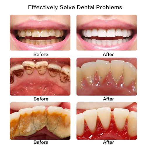 Limpiador dental ultrasónico para el hogar: removedor de placa de sarro, pulidora blanqueadora de dientes// - Imagen 7 de 18