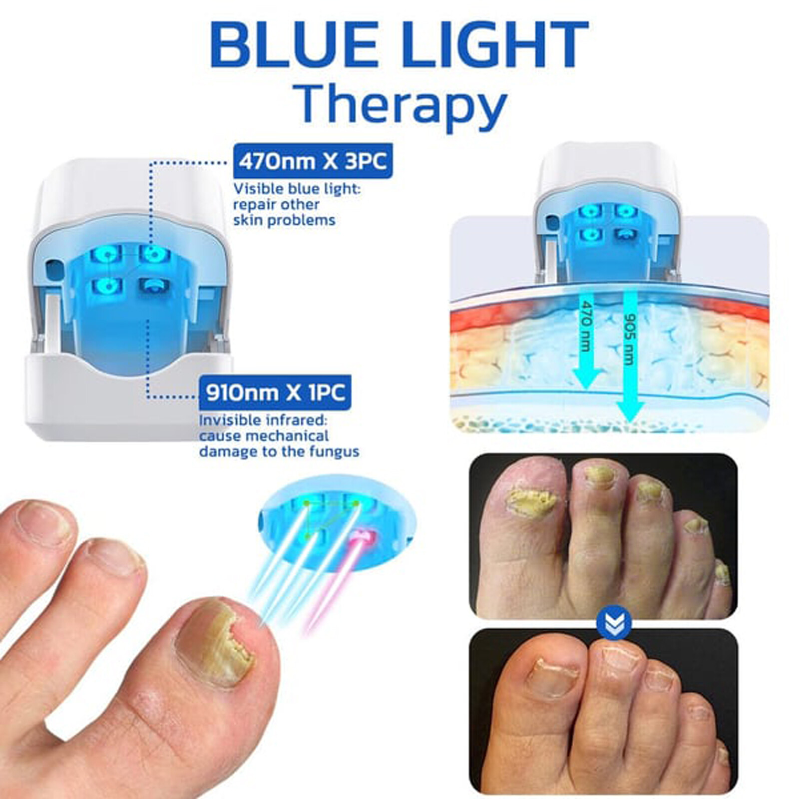 Nail Fungus Care Laser Device Light Therapy Onychomycosis Toes