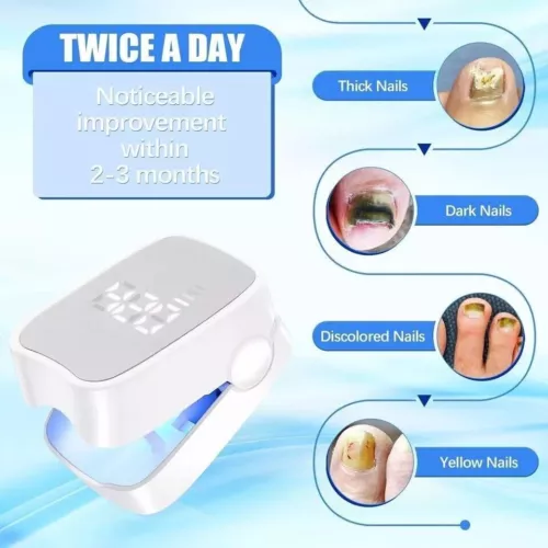 Nail Fungus Laser LED Light Device for Damaged Discoloration of Thick Toenails - Picture 9 of 9