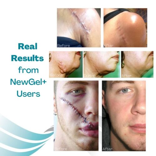Advanced Silicone Scar Treatment Sheets - Medical Grade for All Scars, 4 Count - Picture 11 of 11