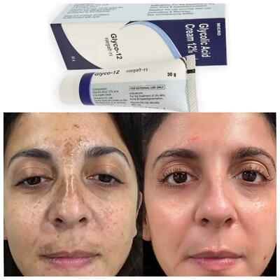 Glyco-12 Cream Glycolic acid 12% cream  Glyco-12 Cream
