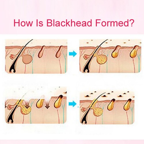 Diamond Blackhead Vacuum Suction Removal Face Cleaner Skin Care Beauty Device - Picture 22 of 24