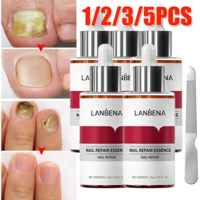 UK LANBENA Nail Repair Essence Remove Onychomycosis Serum Fungal Nail Treatment