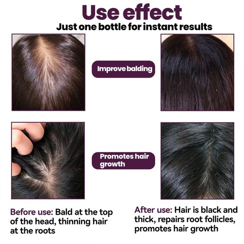 4 Bottles 60ml Hair Growth Foam Promote Nutrition Absorption Activate Follic TPG - Picture 19 of 24
