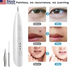 3-speed Laser Plasma Pen Anti-Aging Mole Freckle Spot Removal Pen US Shipping