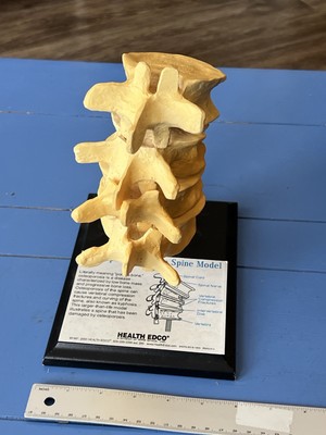 Vintage Health Edco Osteoporosis of the Human Spine Teaching Model, Austin ISD