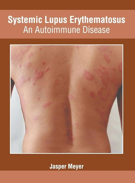 Jasper Meyer | Systemic Lupus Erythematosus | Buch | Englisch (2019) | Gebunden-image
