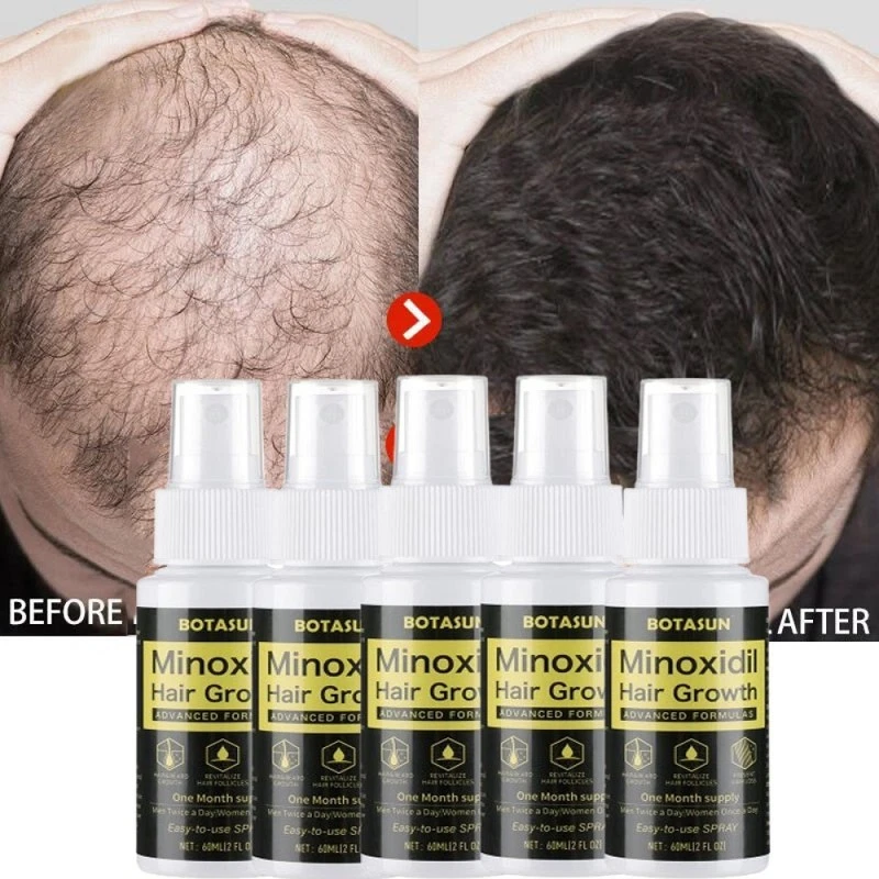 Minoxidil 5% Extra Strength for Men Hair Regrowth Treatment Thicker Hair Growth
Opens in a new windo