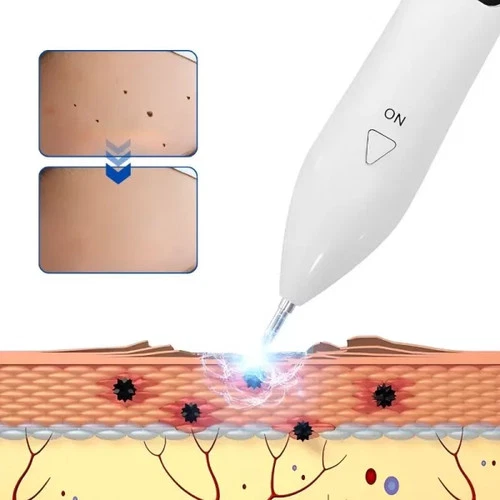 LCD Plasma laser pointer for mole Warzenentferner removal Muttermal Entfernen - Bild 3 von 16