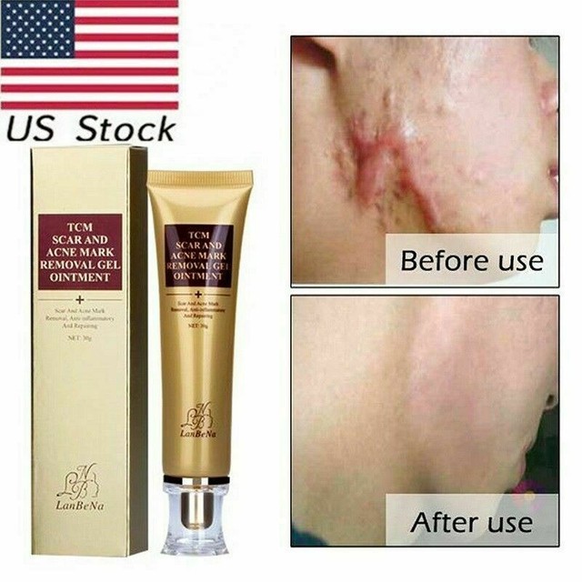 lanbena for stretch marks