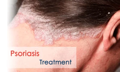 Natural Psoriasis Shampoo – Handmade Relief for Dry, Flaky, Itchy Scalp – 250ml - Image 4 of 4