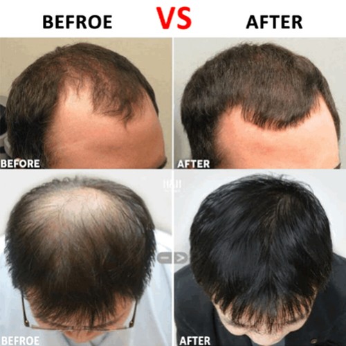 540 Titanium Micro Needle Derma Roller Beard Hair Regeneration Growth Skin Care - Picture 5 of 15
