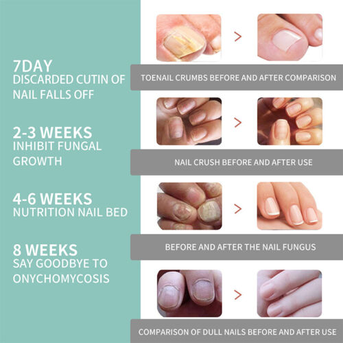 Lápiz de aceite reparador suero de uñas cuidado de uñas cuidado de hongos tratamiento de uñas ❆ ≌ - Imagen 11 de 14