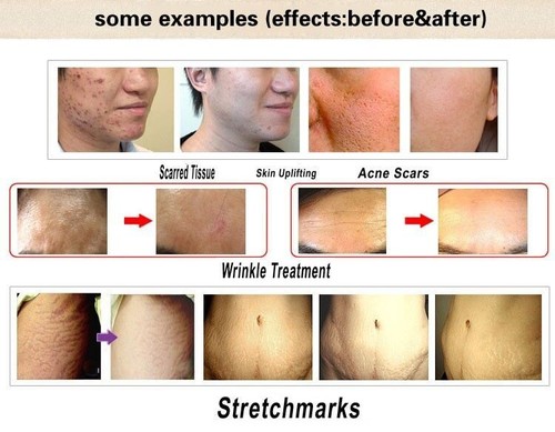 Menge 2 Stck. 2,5 mm DRS 540 Titan Mikronadel Anti-Aging Derma MTS Roller Haut - Bild 6 von 7