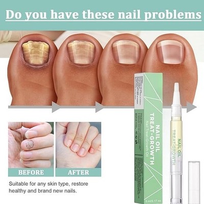 2 Stück Nagelwachstumsöl Stift & Nagelhaut Feuchtigkeitscreme - Vitamin E Nagelverstärker