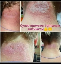 Universal Cream Eczema  Psoriasis Acne and all skin and not and not only