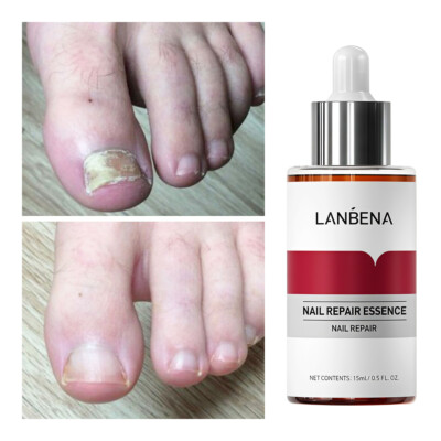 Anti Fungal Nail Treatment Finger Toe Nail Repair Care Fungus Essence Liquid USA