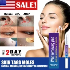 Wart Remover Pen Eliminate Skin Tag Foot Corn Mole Warts Restoration Painless US