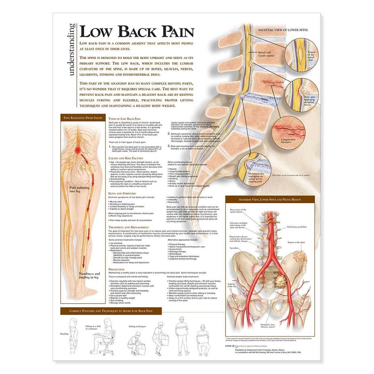 Understanding Low Back Pain Anatomical Chart Anatomical Chart Company - Image 5