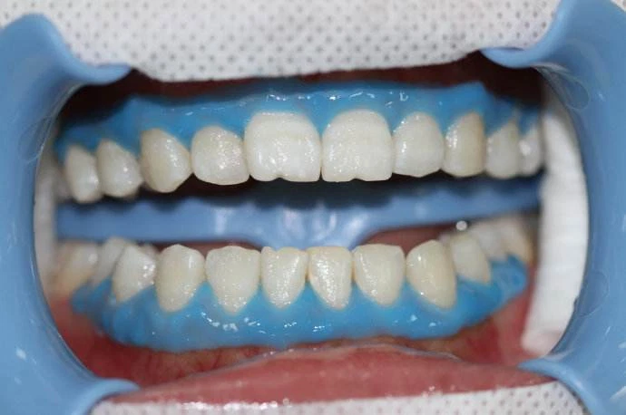 Protector de goma barrera gingival presa líquida 10 piezas x 3 ml FDA MSDS EZGO Foto 4 de 4