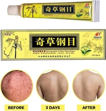 Cream Psoriasis Eczema Treatment Dermatitis Skin for Body Relief Natural