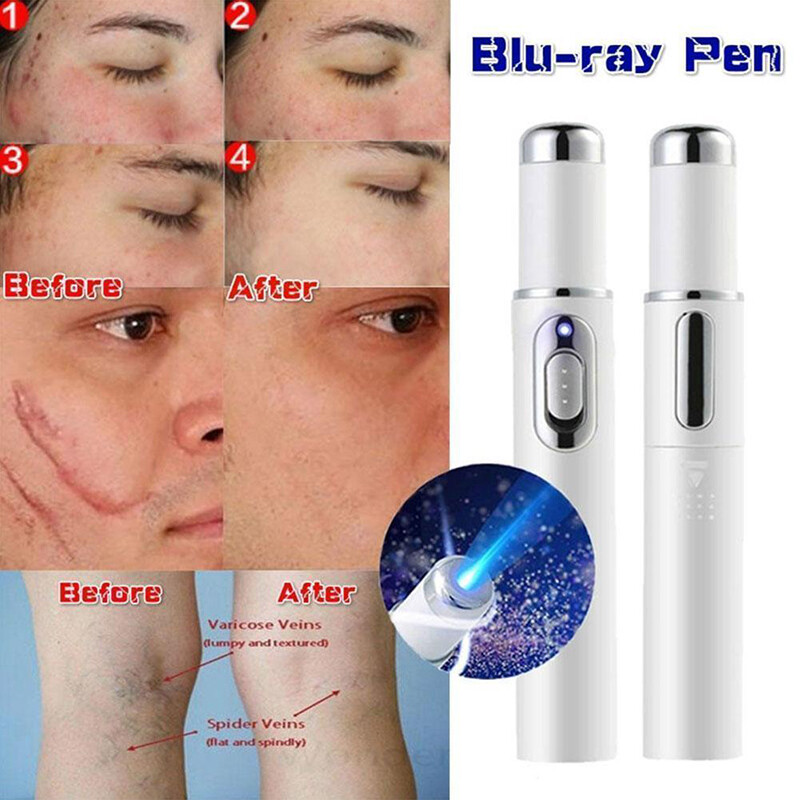 Blue Light Therapys Pen for Varicose Veins Therapys Wrinkle Acne Laser