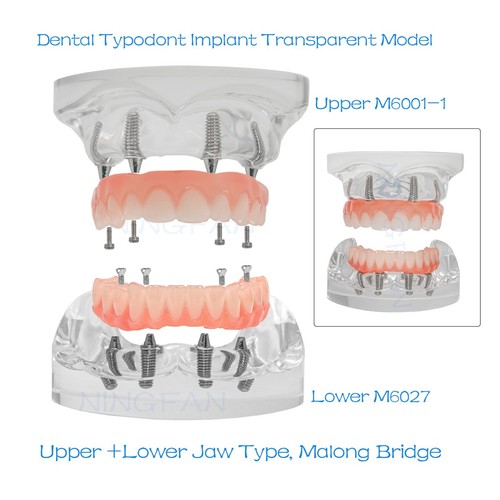 Dental Implant All on 4 Overdenture Model Upper/Lower Jaw with 2/4 Screw, Clear - Picture 67 of 67
