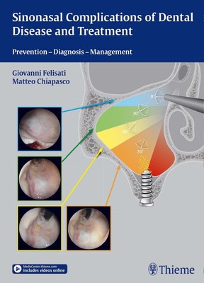 Sinonasal Complications of Dental Disease and Treatment ~ Gi ... 9783131997012