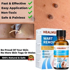 Wart Remover Liquid Skin Tag Mole Remover Eliminate Feet Corn Wart Remove Liquid
