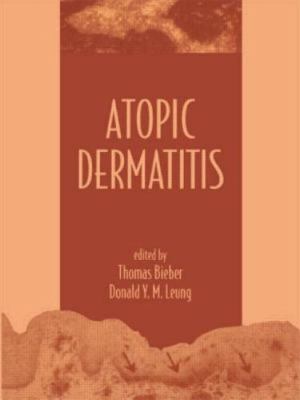 Atopic Dermatitis by Bieber, Thomas; Leung, Donald Y. M.; Bieber, Bieber