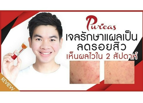 Puricas Dragon's Blood Gel Remove Keloid Surgery Acne Scars Red Mark Spot 8g/20g - Picture 3 of 8