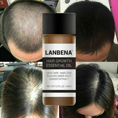 Lanbena Powerful Natural Hair Loss Treatment Fast Hair Growth Essential Oil 20ml