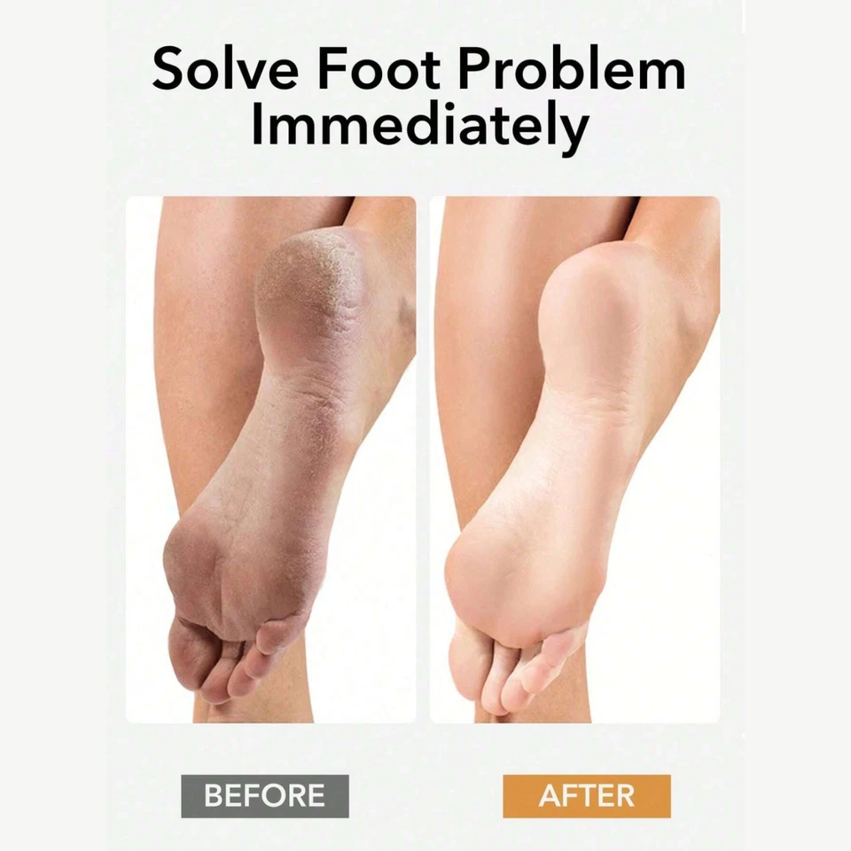 Kit de pedicura removedor de callos de piel dura de 2 lados lima raspador de pies profesional Foto 3 de 4