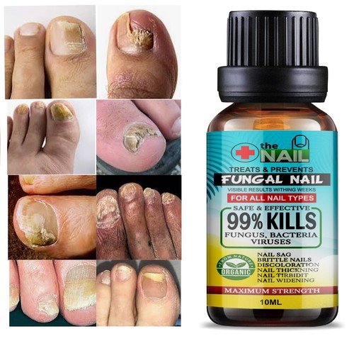 Tratamiento de hongos en las uñas Anti infección por hongos Cuidado de infecciones por hongos en las uñas de los pies Reino Unido - Imagen 2 de 5