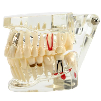 3D Dental Implant Disease Teeth Model Ortho Restoration Bridge Demo Model