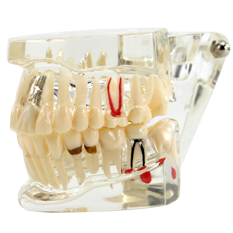 Modèle D'étude Dentaire Transparent Pour Implants - Entraînement Et Démonstration - Neuf