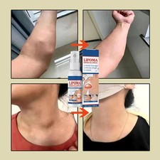 50ML Lipomheilung Reduction Spray, Instant LumpFree Lipoma Removal Spray