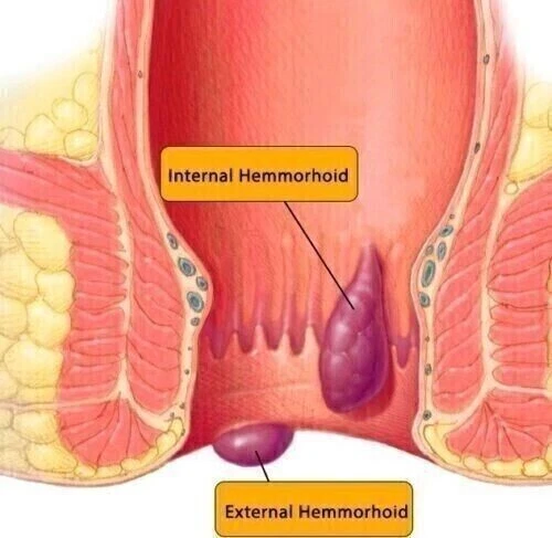 Hadensa Ayurvedic 50 Pills Hemorrhoids & Piles Pain Relief Itching Swelling 2026 - Picture 4 of 7